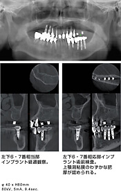 歯科用CT-撮影画像5