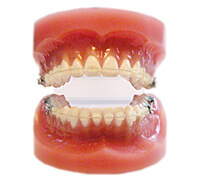 矯正歯科装置の画像